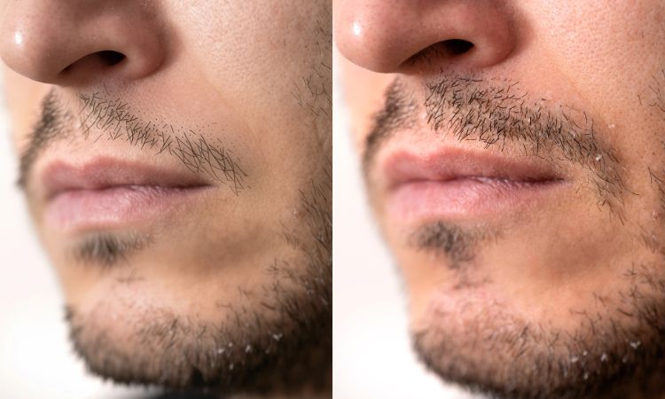 Moustache-Transplant