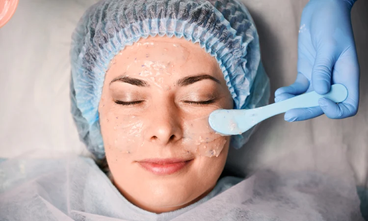 Chemical Peeling