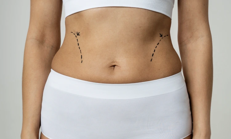 Liposuction