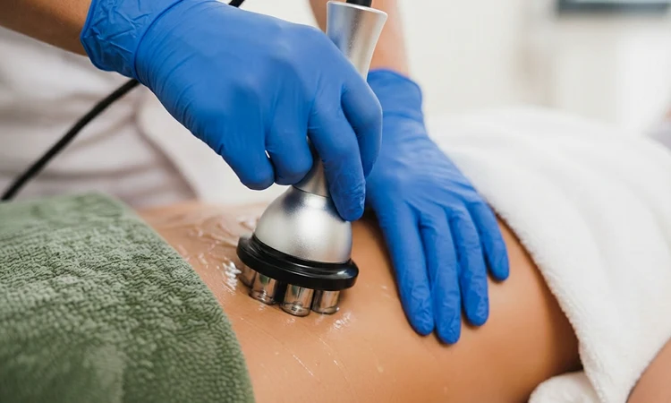 Radiofrequency (RF) Skin Tightening