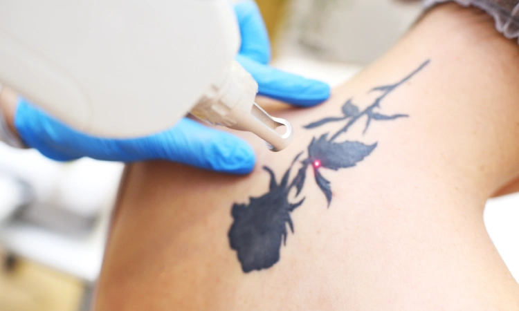Tattoo Removal